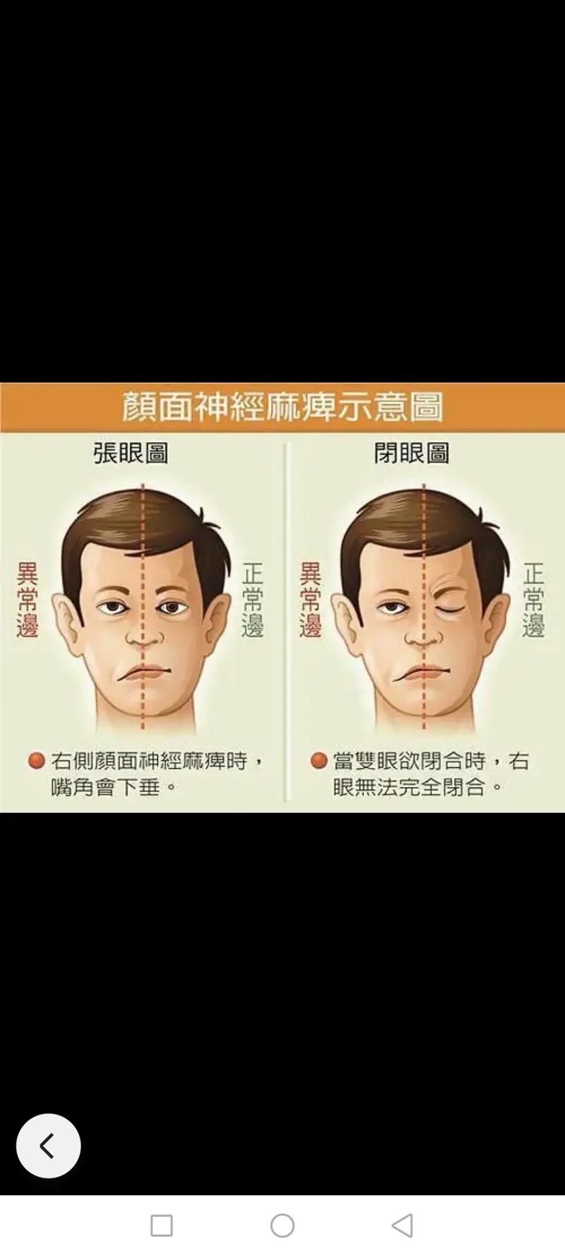 面神经麻痹
