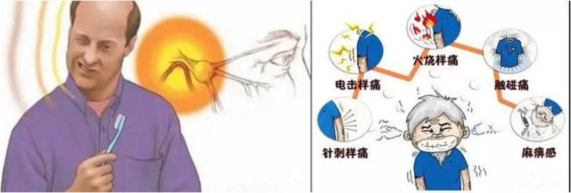 三叉神经痛
