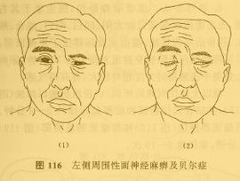 面神经麻痹，一个让人头疼的词汇，如何在日常生活中有效应对？本文将通过具体案例和实用操作指南，帮助你了解并解决这一常见问题。