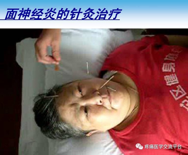 面神经麻痹：寻找康复之路