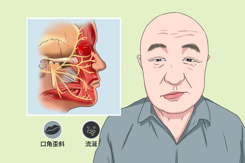 面神经炎：如何有效应对面部肌肉无力