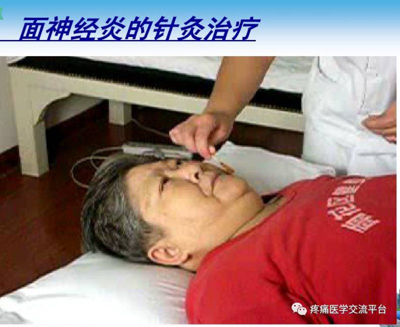 面神经治疗